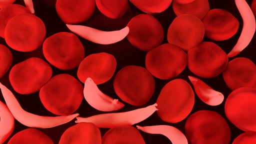 Sickle Cell Stakeholders Advocate Genotype Testing