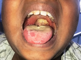 Diphtheria: 30 Children Die In Yobe, 42 Hospitalised