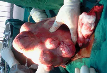 Fibroid Treatment: How Sound Waves Are Giving Nigerian Women an Alternative to Surgery